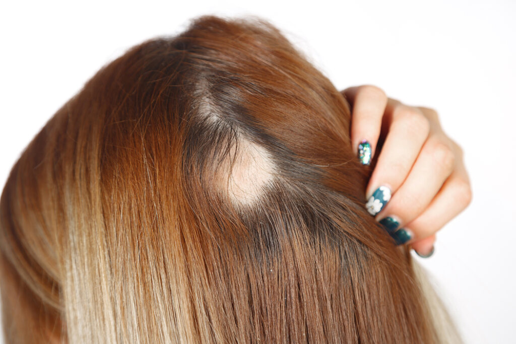 alopecie causes traitements solutions