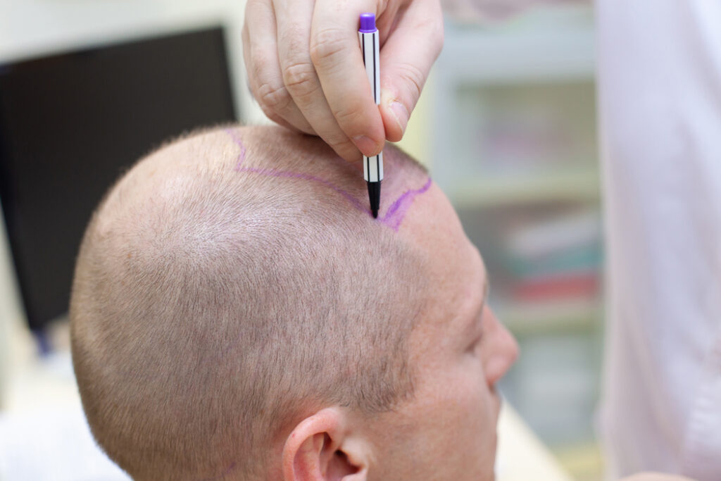 alopecie causes traitements solutions
